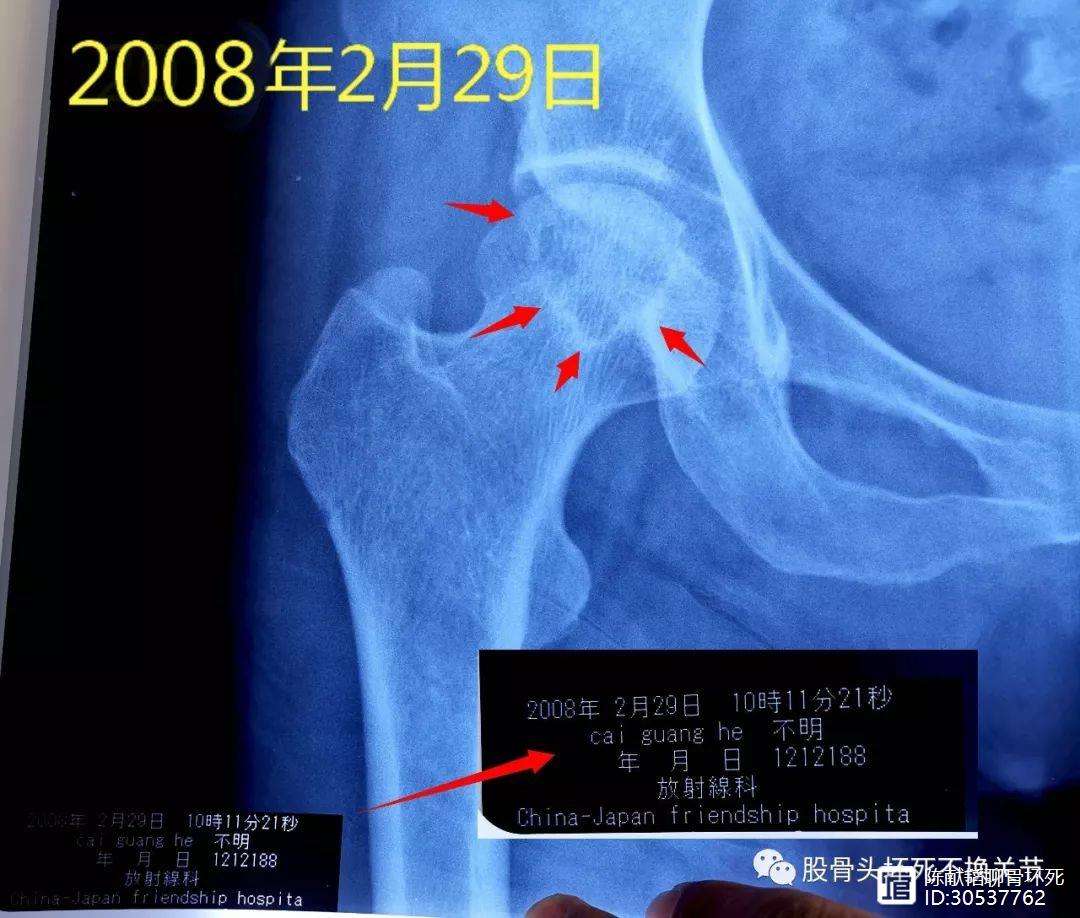 黄冈人工骨头医保报销多少(人工骨头医保报销多少比例)