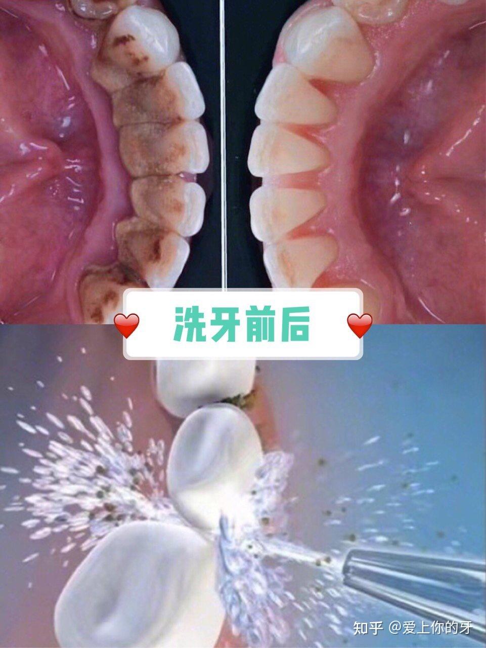 黄冈洗牙可以用医保吗(洗牙可以用医保吗,报销比例多少)